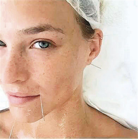 萊昂納多前女友、以色列內(nèi)衣超模芭兒·萊法利（Bar Refaeli）曾在社交平臺(tái)上分享了自己面部針灸時(shí)的樣子，照片中芭兒素顏正躺，臉上多個(gè)穴位規(guī)則布針。(美國(guó)《僑報(bào)》摘自網(wǎng)絡(luò)圖片)