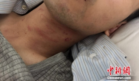 受傷的謝某。 鐘欣 攝